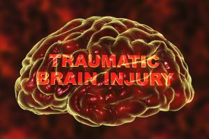 The Different Types of Traumatic Brain Injury (TBI)